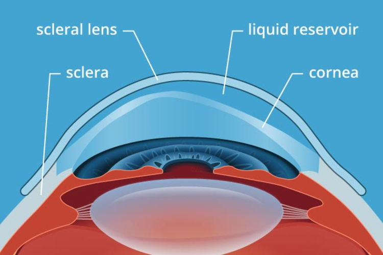 Scleral lenses for keratoconus in Cambridge